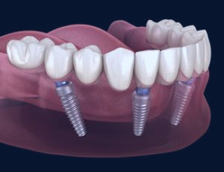 Dental Implants | How Many Dental Implants Do I Need | Mason Dental PC